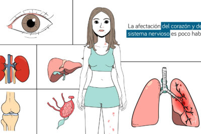 sintomas y tratamiento